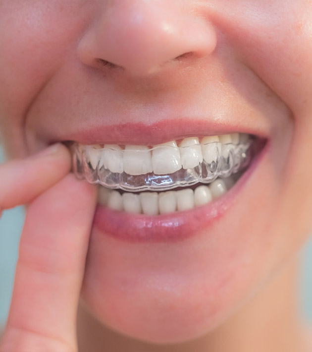 What is Invisalign® Lite?